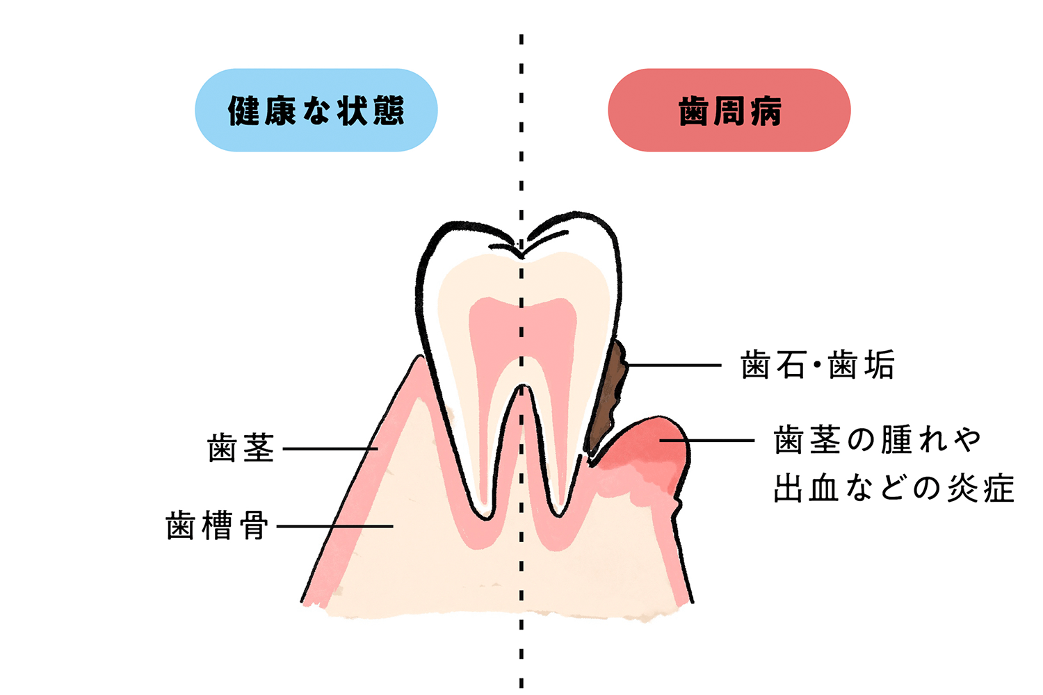 健康な歯と歯周病の歯を表す図